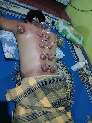 Pijat urut, Terapi bekam