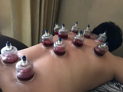 Bekam,Totok dan pijat bu Ati home care