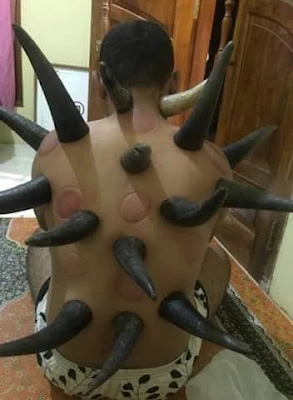 Griya sehat bekam karomah tanduk THIBBUN NABAWI