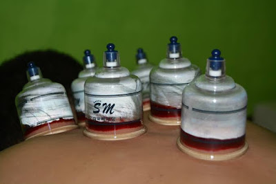 Terapi Bekam Banjarsari Ummi