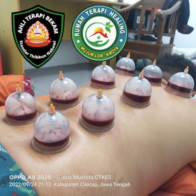 TERAPI GURAH HIDUNG | BEKAM SUNNAH | PIJAT TRADISIONAL MODERN | PIJAT URAT SYARAF | ARIS MUSTOFA CILACAP